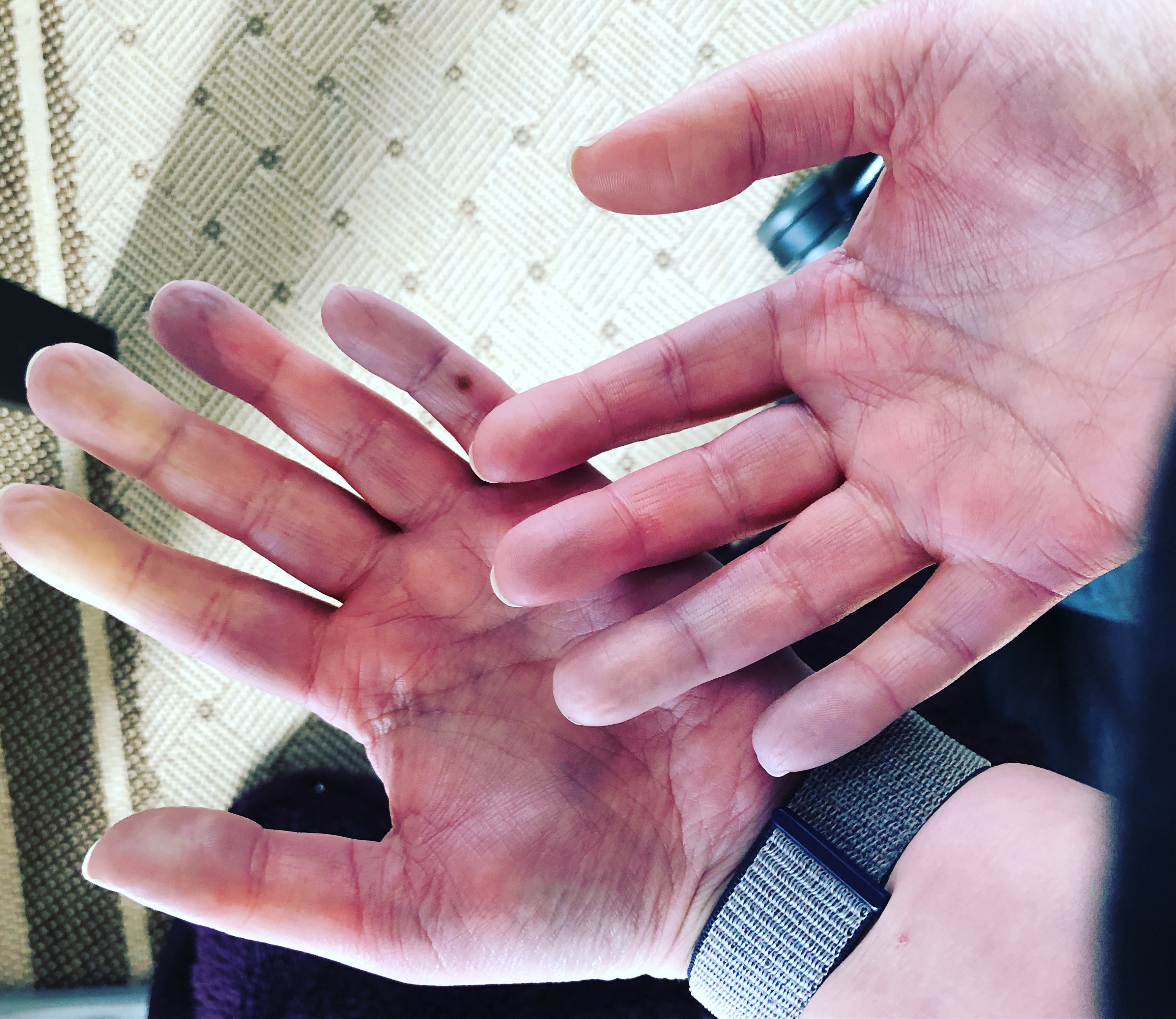 A hand with blue and white fingers indicative of Reynaud's phenomenon.