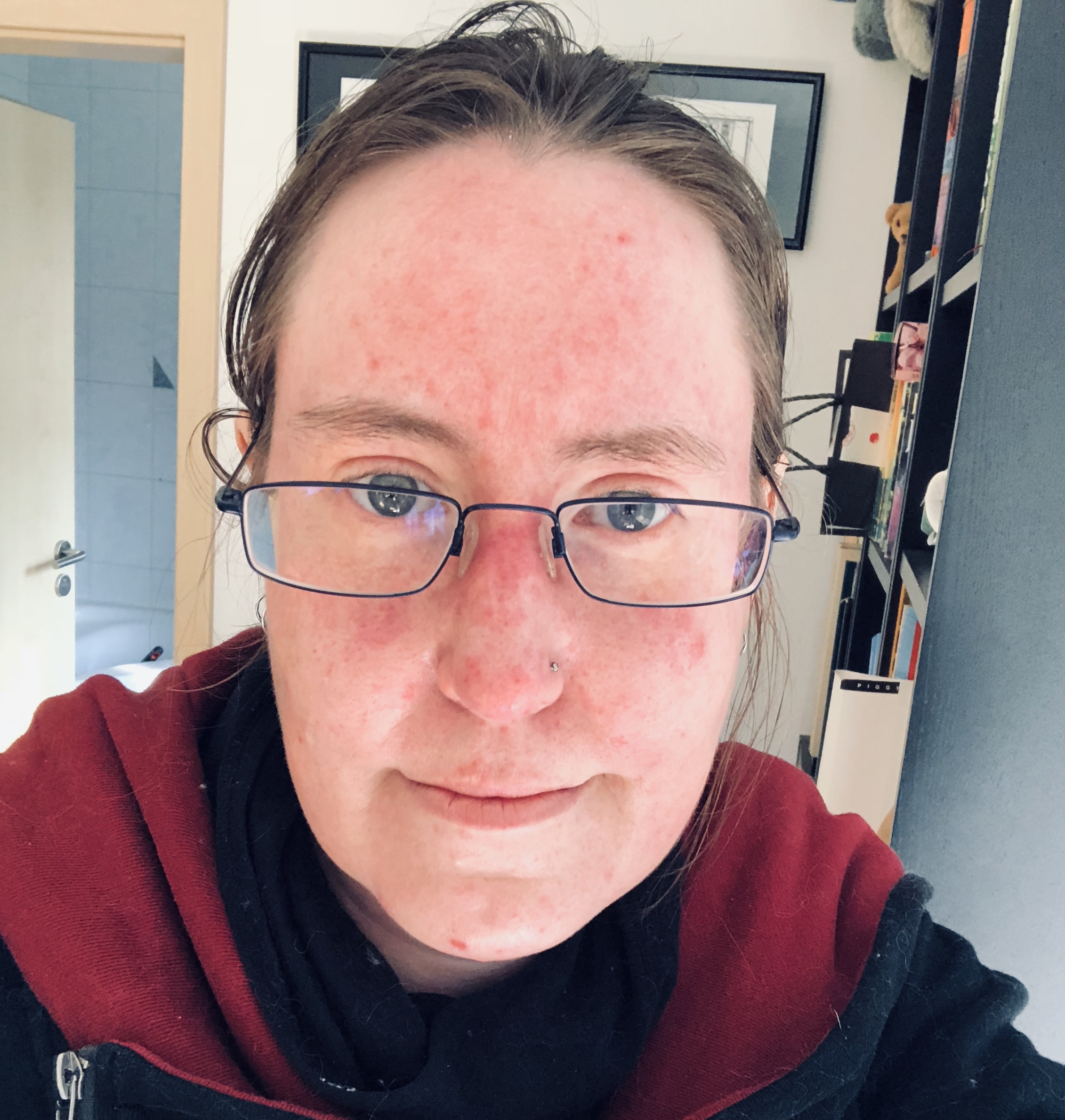 Even with contrast turned down in the photo, the acne is visible. And it hurts.